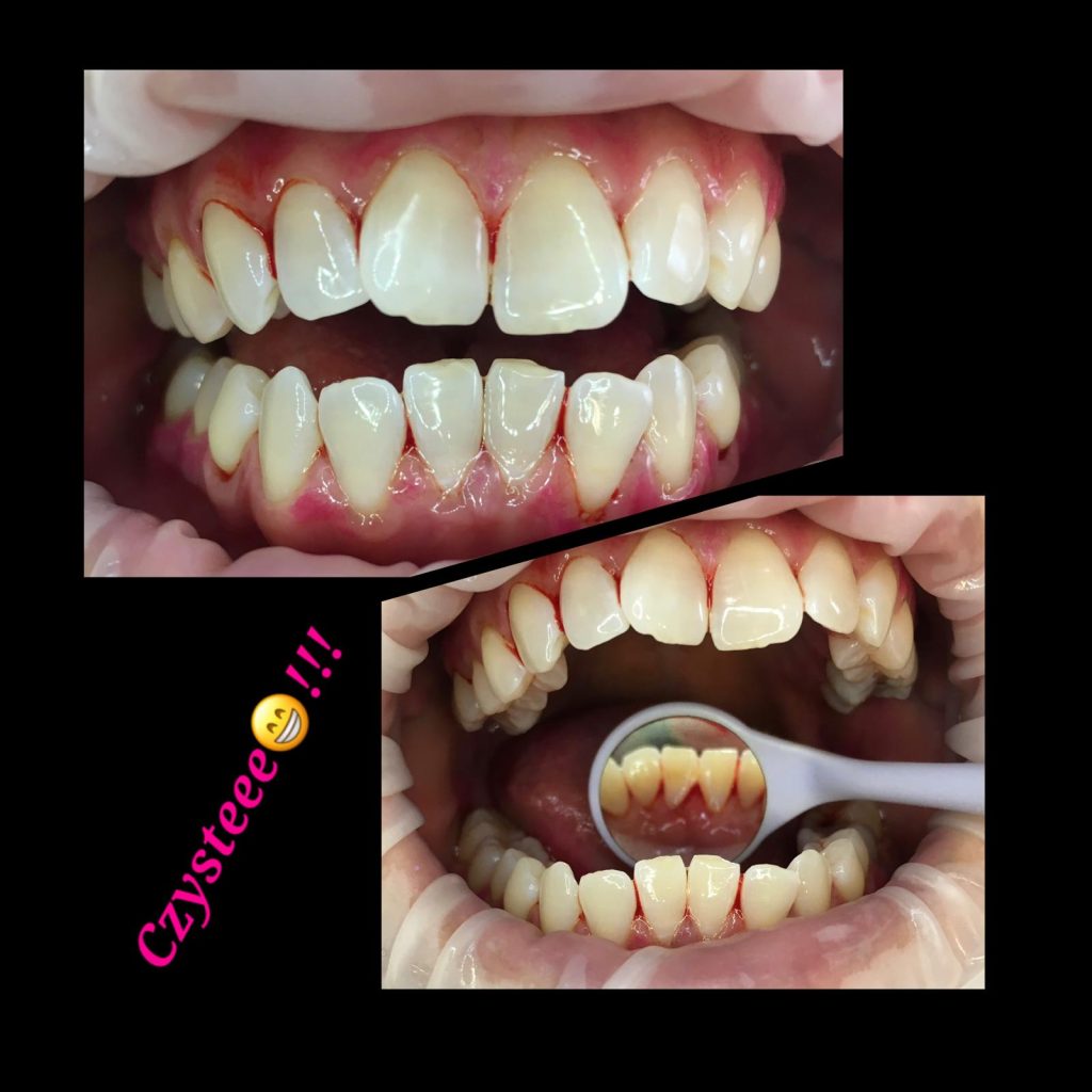 Czyszczenie zębów Szczecin – przed i po Czyszczenie zębów – efekt przed i po zabiegu w gabinecie stomatologicznym w Szczecinie
