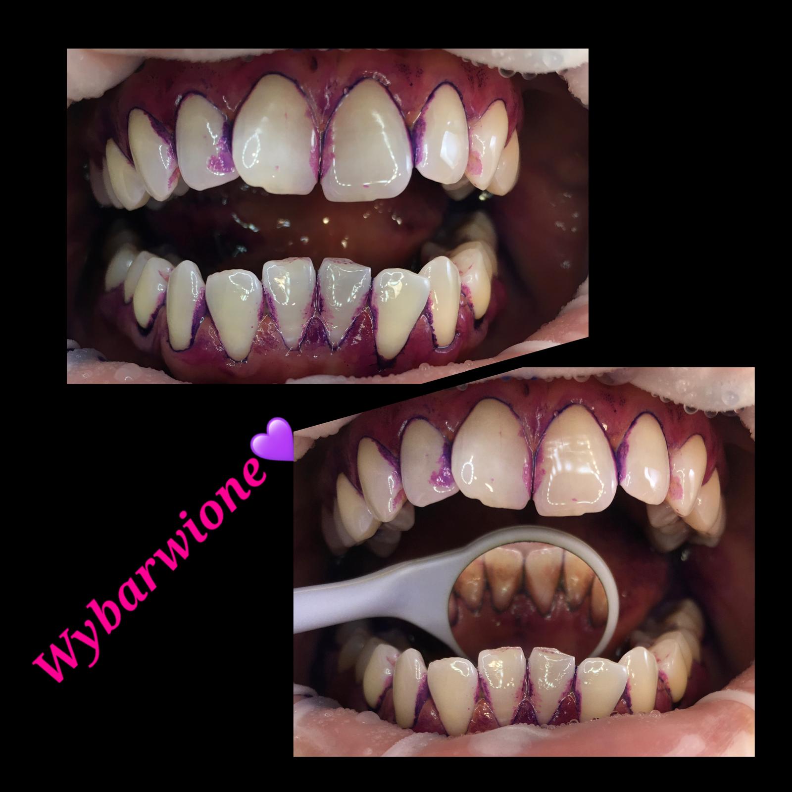 Wybarwienie płytki nazębnej przed higienizacją Wybarwione zęby przed zabiegiem higienizacji – pokaz płytki nazębnej