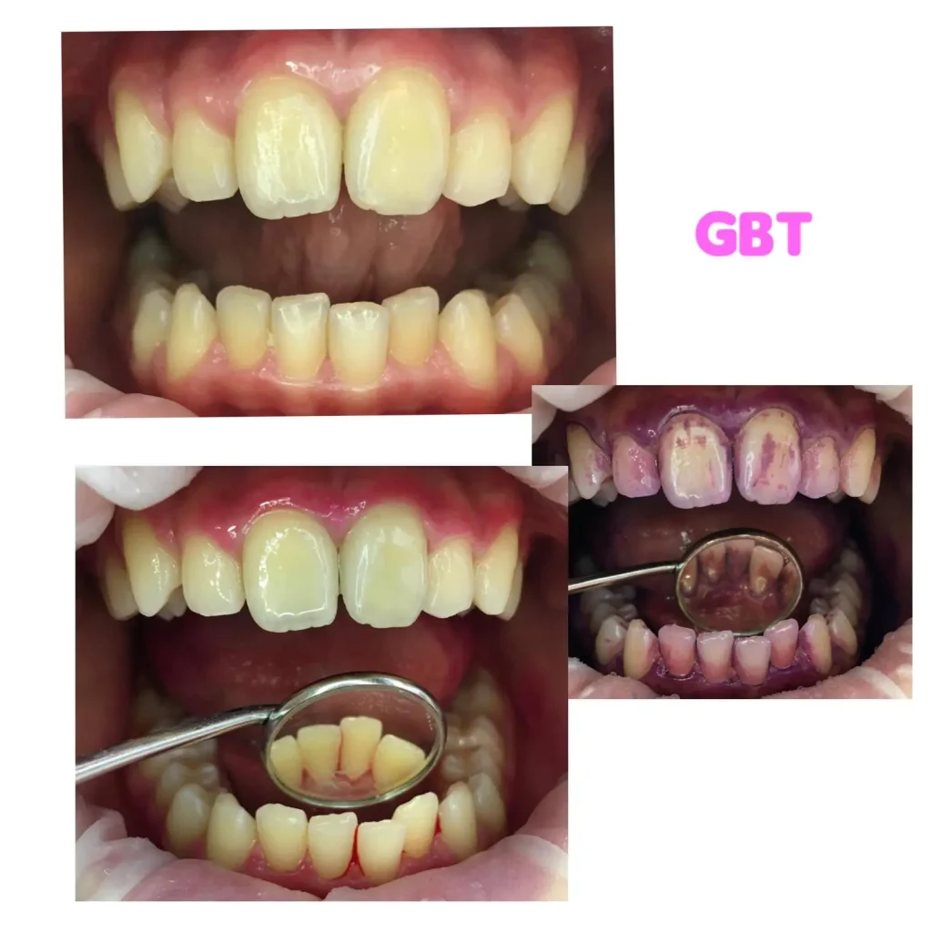 GBT higienizacja zębów – efekt przed i po zabiegu w gabinecie stomatologicznym Marlena Sołtysik-Drebot Szczecin