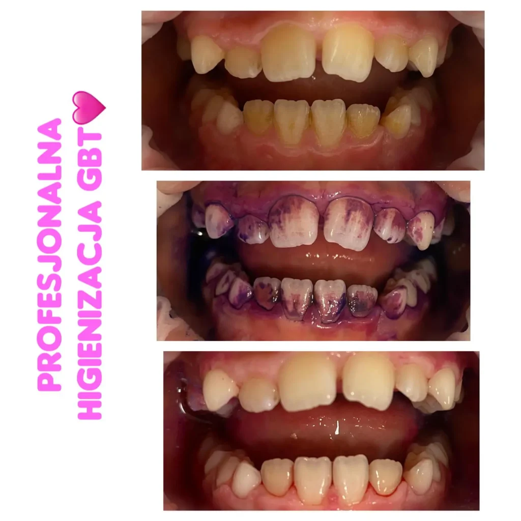 GBT higienizacja zębów – etapy zabiegu: przed, barwienie biofilmu i efekt końcowy po czyszczeniu w gabinecie stomatologicznym Szczecin